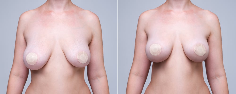 Breast Augmentation / Breast Lift: Garden Plastic Surgery Center