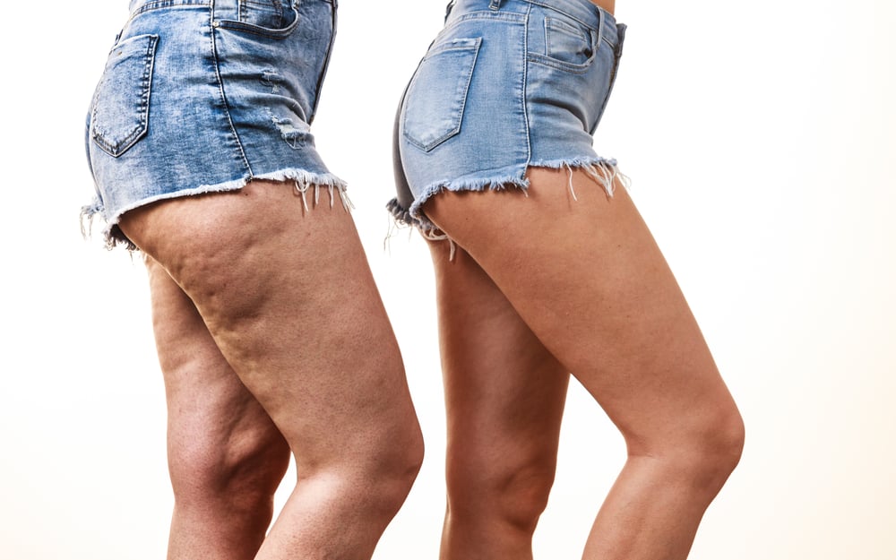 Cellulite Reduction Before (Left) and After (Right)