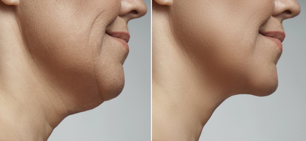 Facelift Before and After: Garden Plastic Surgery Center