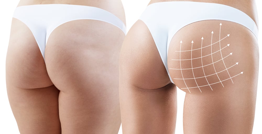 Gluteal Augmentation Services Center: Garden Plastic Surgery Center