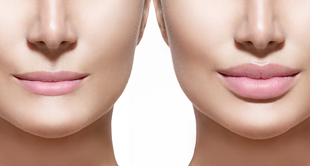 Lip Filler Injection: Lip Augmentaiton - Garden Plastic Surgery & MedAesthetics