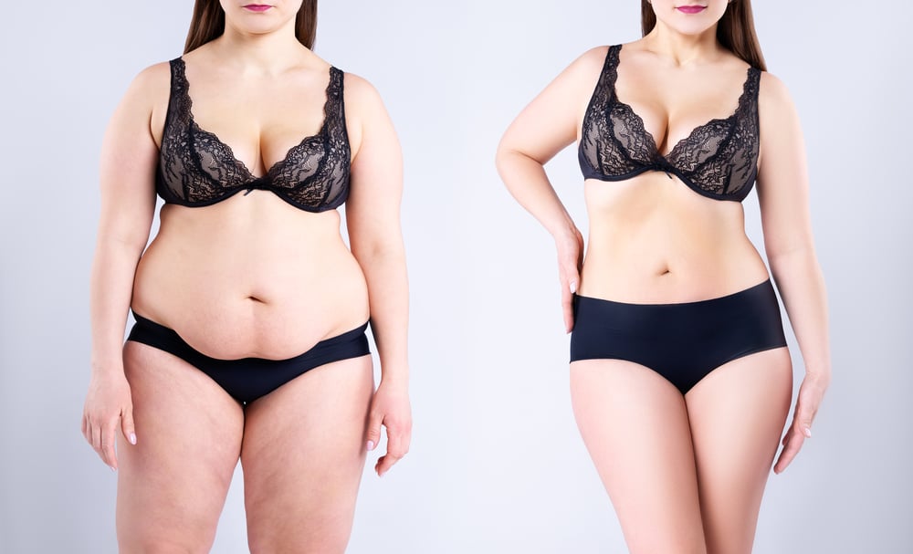 Liposuction Consultation: Garden Plastic Surgery Center