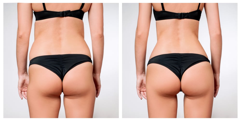 Liposuction & Gluteal Enhancement (Brazillian Butt Lift) by Garden Plastic Surgery and MedAesthetics