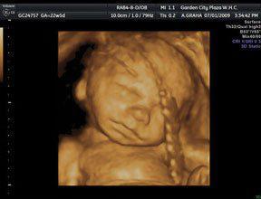 The 3D / 4D Ultrasound