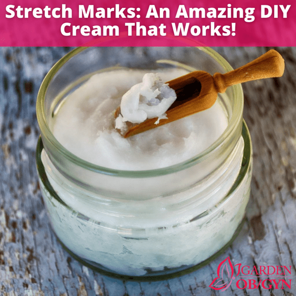 An Effective DIY Solution for Stretch Marks