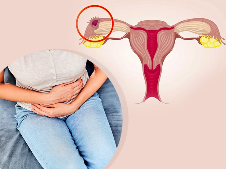 What is Ectopic Pregnancy?