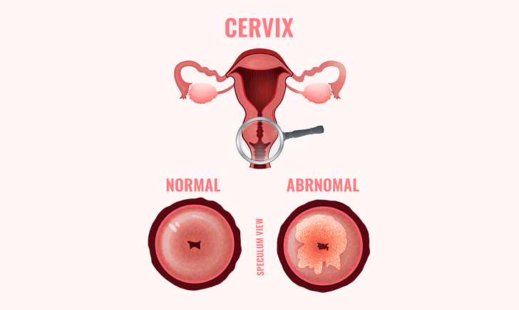 What is a Pap Smear?