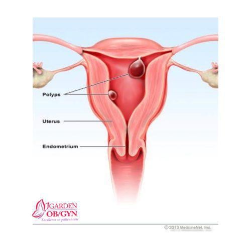 How to Recognize & Treat Uterine Polyps